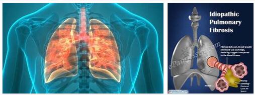 Idiopathic Pulmonary Fibrosis